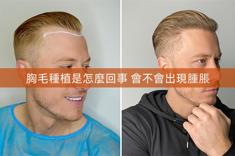胸毛種植是怎麼回事 會不會出現腫脹 胸毛種植是怎麼回事 會不會出現腫脹