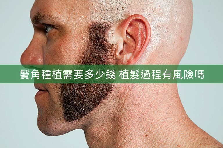 鬢角種植需要多少錢 植髮過程有風險嗎