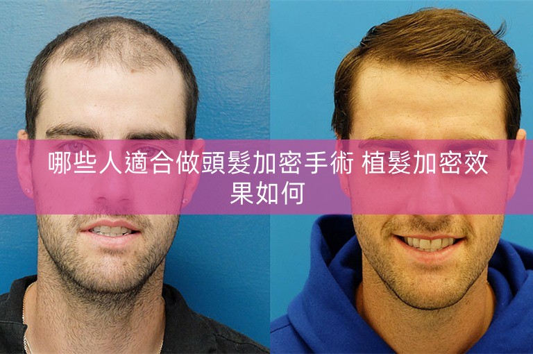 哪些人適合做頭髮加密手術 植髮加密效果如何