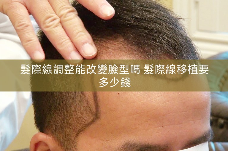 髮際線調整能改變臉型嗎 髮際線移植要多少錢