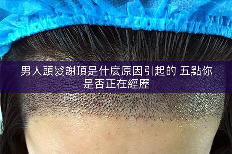 男人頭髮謝頂是什麼原因引起的 五點你是否正在經歷