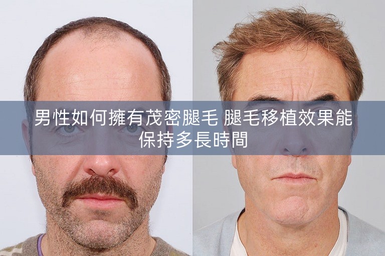 男性如何擁有茂密腿毛 腿毛移植效果能保持多長時間 男性如何擁有茂密腿毛 腿毛移植效果能保持多長時間