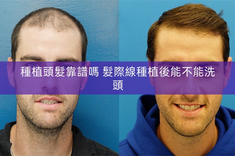 種植頭髮靠譜嗎 髮際線種植後能不能洗頭