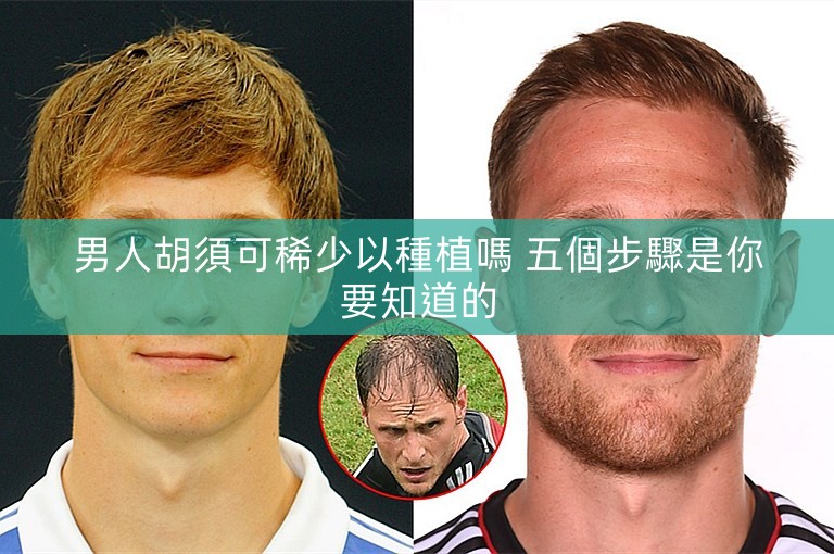 男人胡須可稀少以種植嗎 五個步驟是你要知道的 男人胡須可稀少以種植嗎 五個步驟是你要知道的