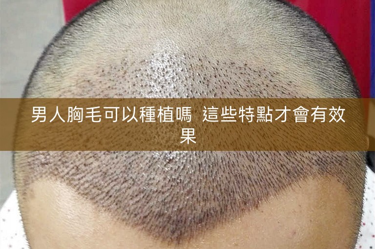 男人胸毛可以種植嗎 這些特點才會有效果 男人胸毛可以種植嗎 這些特點才會有效果