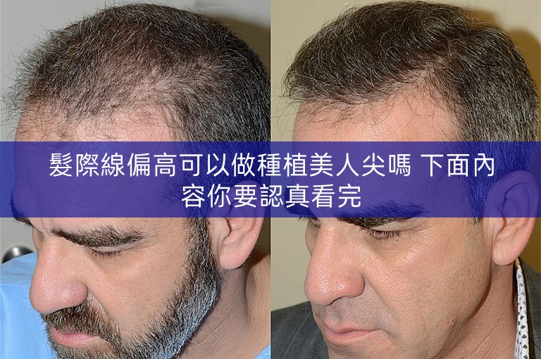 髮際線偏高可以做種植美人尖嗎 下面內容你要認真看完