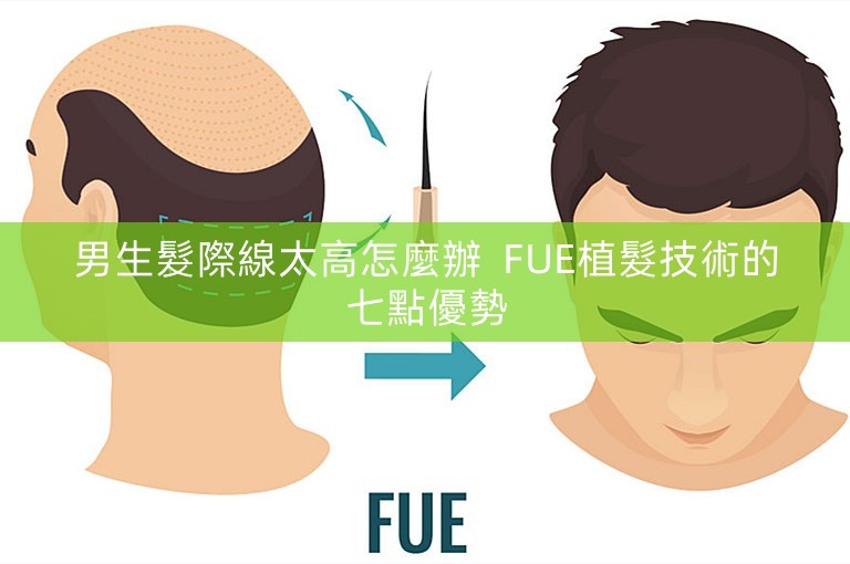 男生髮際線太高怎麼辦  FUE植髮技術的七點優勢