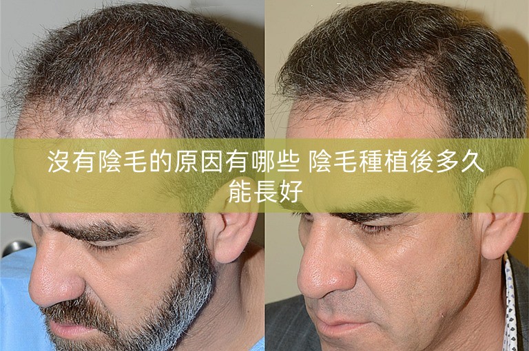 沒有陰毛的原因有哪些 陰毛種植後多久能長好 沒有陰毛的原因有哪些 陰毛種植後多久能長好