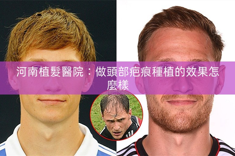 河南植髮醫院：做頭部疤痕種植的效果怎麼樣