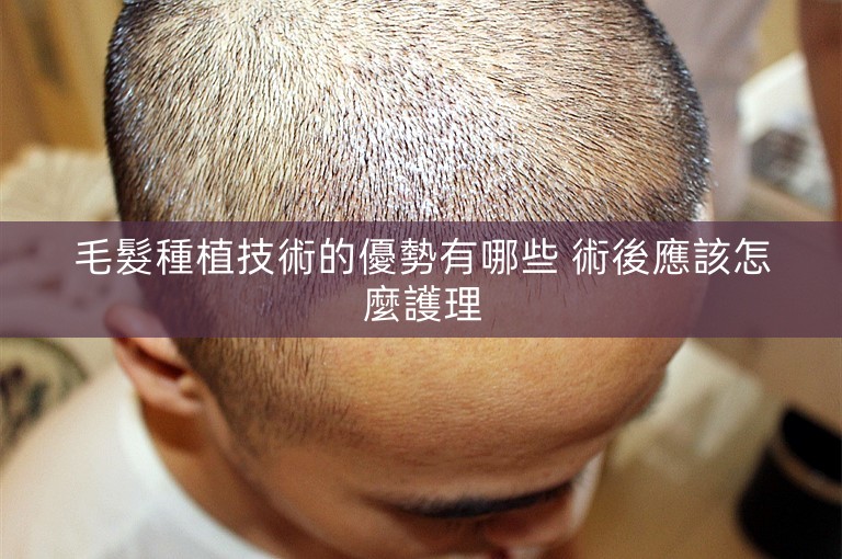 毛髮種植技術的優勢有哪些 術後應該怎麼護理