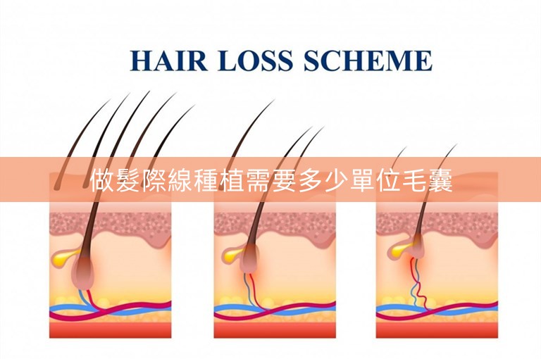 做髮際線種植需要多少單位毛囊