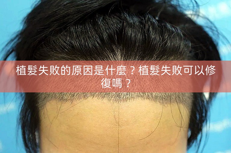 植髮失敗的原因是什麼？植髮失敗可以修復嗎？