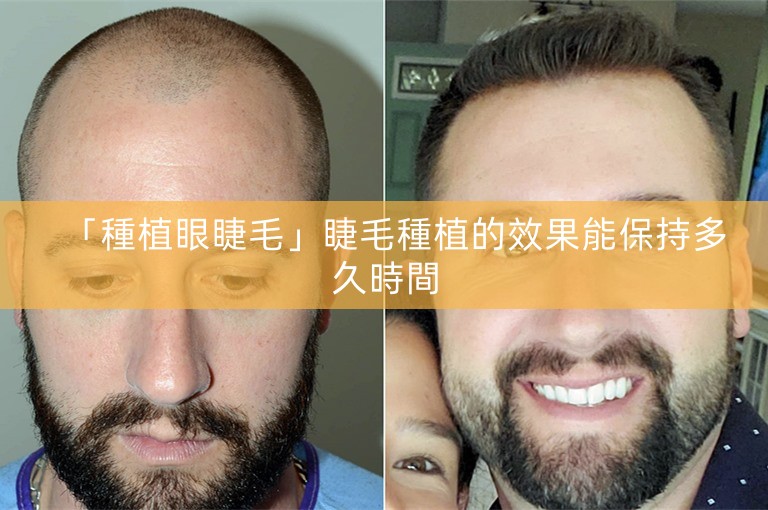 「種植眼睫毛」睫毛種植的效果能保持多久時間 「種植眼睫毛」睫毛種植的效果能保持多久時間