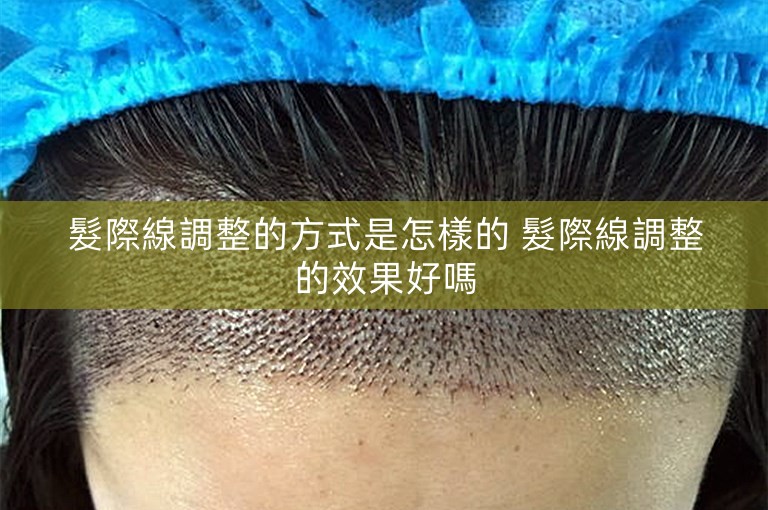 髮際線調整的方式是怎樣的 髮際線調整的效果好嗎