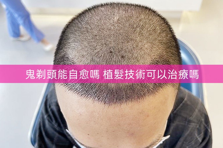 鬼剃頭能自愈嗎 植髮技術可以治療嗎