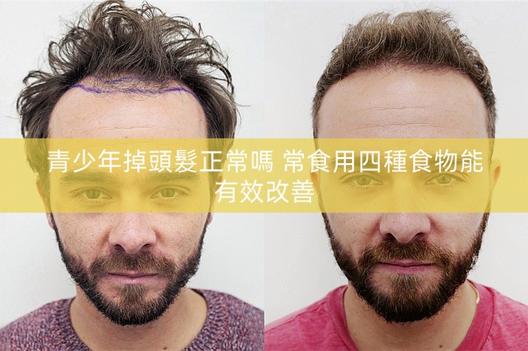 青少年掉頭髮正常嗎 常食用四種食物能有效改善 青少年掉頭髮正常嗎 常食用四種食物能有效改善