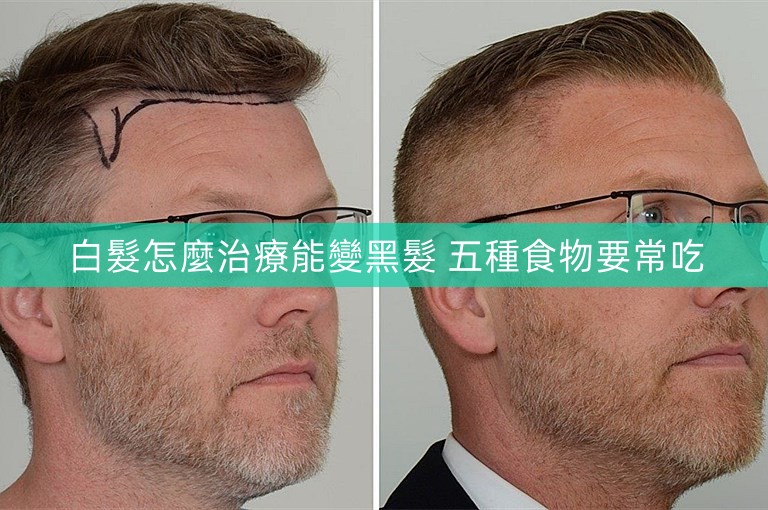 白髮怎麼治療能變黑髮 五種食物要常吃 白髮怎麼治療能變黑髮 五種食物要常吃