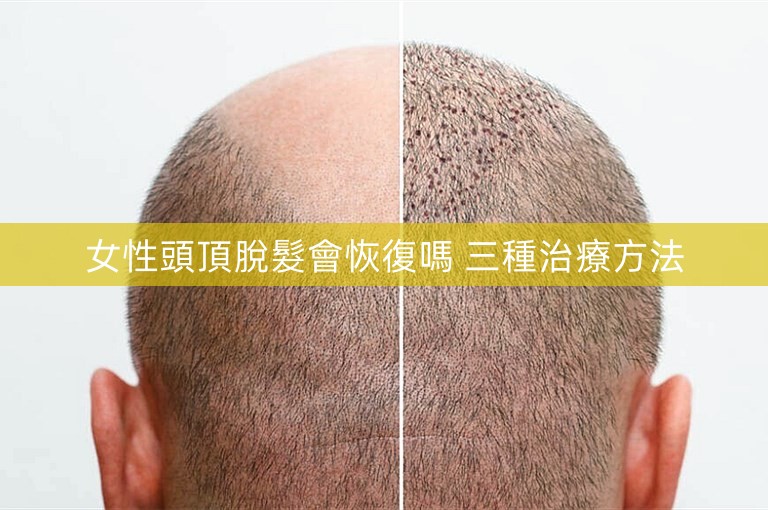 女性頭頂脫髮會恢復嗎 三種治療方法