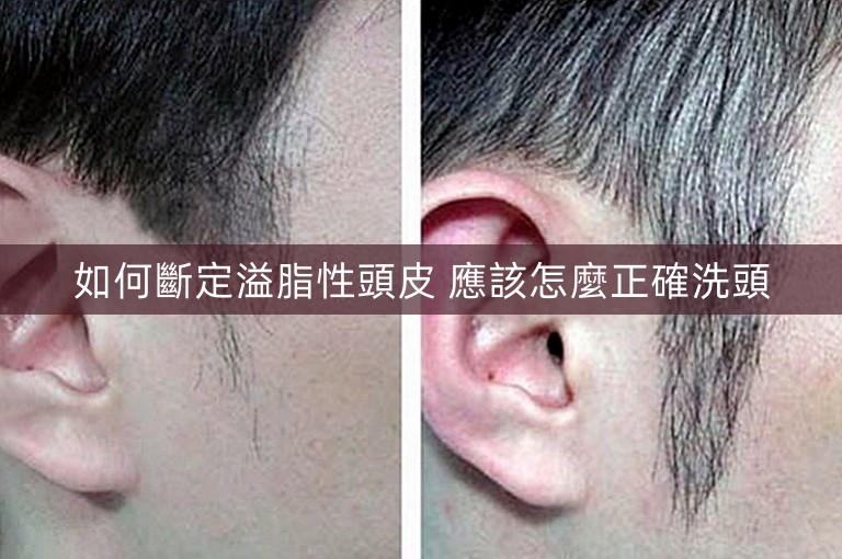 如何斷定溢脂性頭皮 應該怎麼正確洗頭