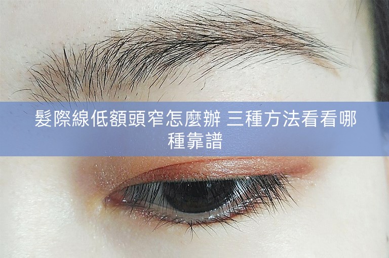 髮際線低額頭窄怎麼辦 三種方法看看哪種靠譜 髮際線低額頭窄怎麼辦 三種方法看看哪種靠譜