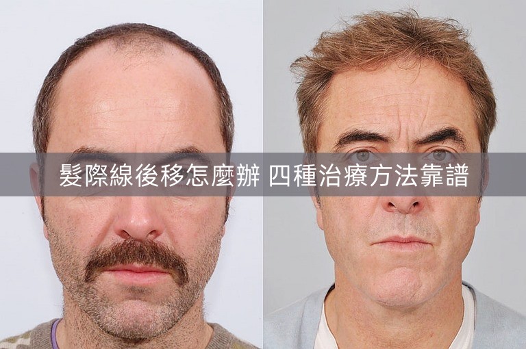 髮際線後移怎麼辦 四種治療方法靠譜