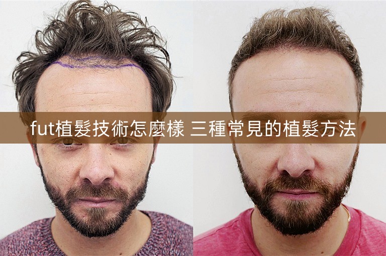fut植髮技術怎麼樣 三種常見的植髮方法