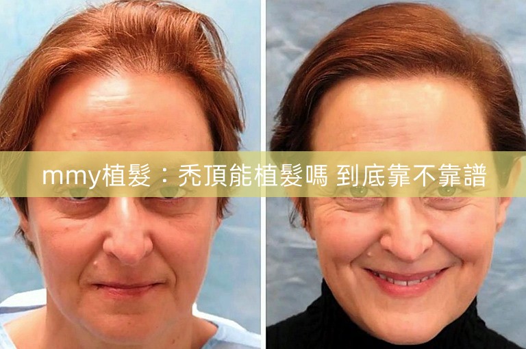 mmy植髮:禿頂能植髮嗎 到底靠不靠譜 mmy植髮:禿頂能植髮嗎 到底靠不靠譜