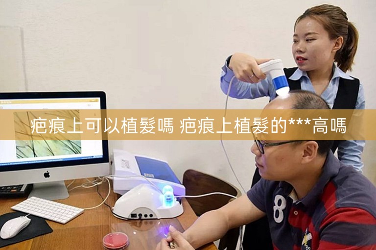 疤痕上可以植髮嗎 疤痕上植髮的***高嗎