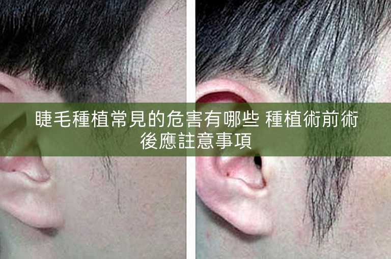 睫毛種植常見的危害有哪些 種植術前術後應註意事項