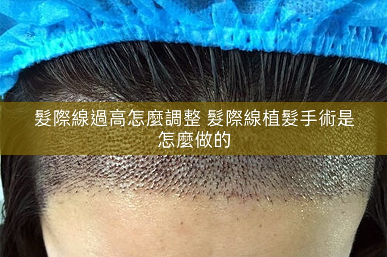 髮際線過高怎麼調整 髮際線植髮手術是怎麼做的