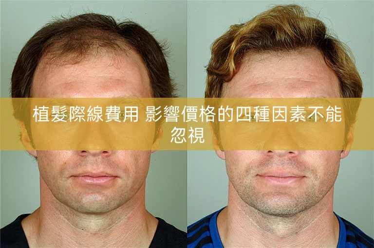 植髮際線費用 影響價格的四種因素不能忽視