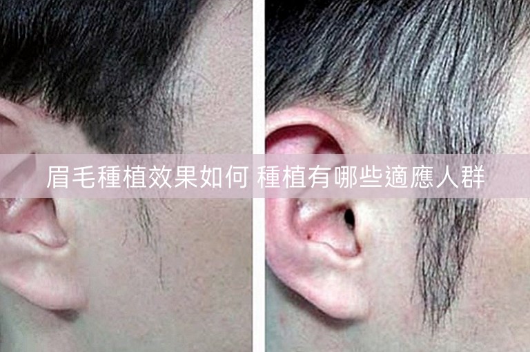 眉毛種植效果如何 種植有哪些適應人群