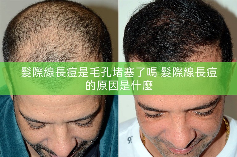 髮際線長痘是毛孔堵塞了嗎 髮際線長痘的原因是什麼