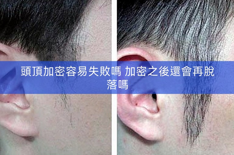 頭頂加密容易失敗嗎 加密之後還會再脫落嗎