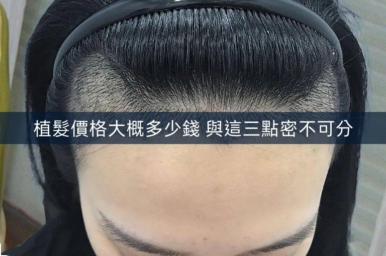 植髮價格大概多少錢 與這三點密不可分