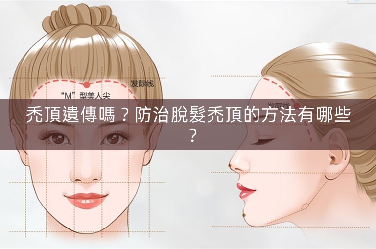 禿頂遺傳嗎？防治脫髮禿頂的方法有哪些？