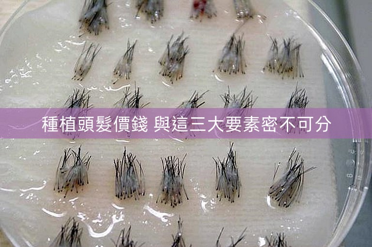 種植頭髮價錢 與這三大要素密不可分