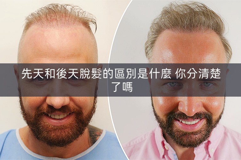 先天和後天脫髮的區別是什麼 你分清楚了嗎