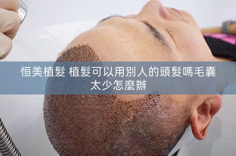 恒美植髮 植髮可以用別人的頭髮嗎毛囊太少怎麼辦