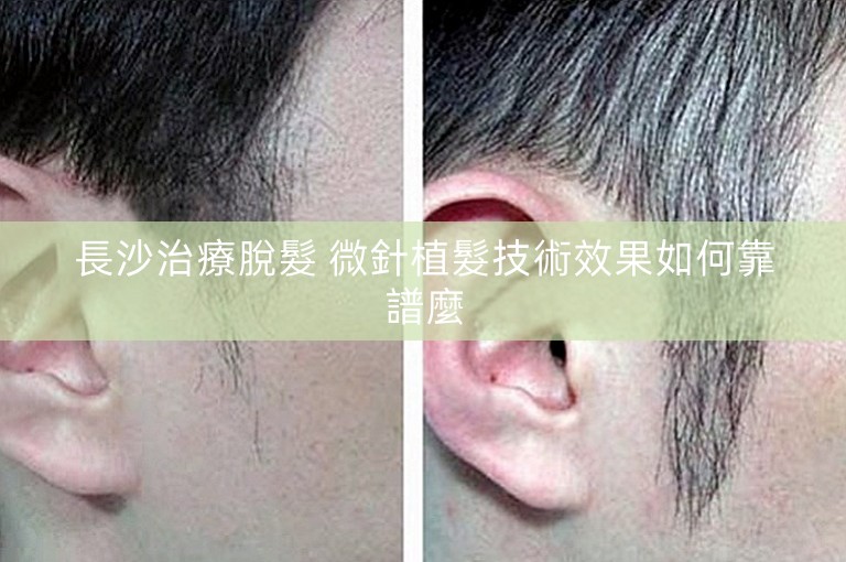 長沙治療脫髮 微針植髮技術效果如何靠譜麼