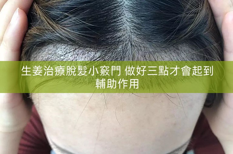 生姜治療脫髮小竅門 做好三點才會起到輔助作用 生姜治療脫髮小竅門 做好三點才會起到輔助作用