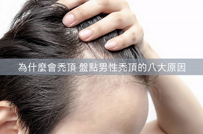 為什麼會禿頂 盤點男性禿頂的八大原因 為什麼會禿頂 盤點男性禿頂的八大原因