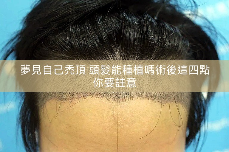 夢見自己禿頂 頭髮能種植嗎術後這四點你要註意