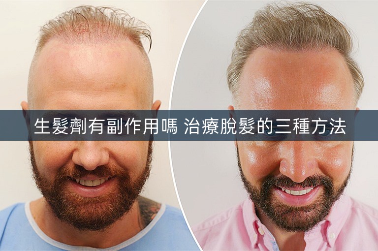 生髮劑有副作用嗎 治療脫髮的三種方法 生髮劑有副作用嗎 治療脫髮的三種方法