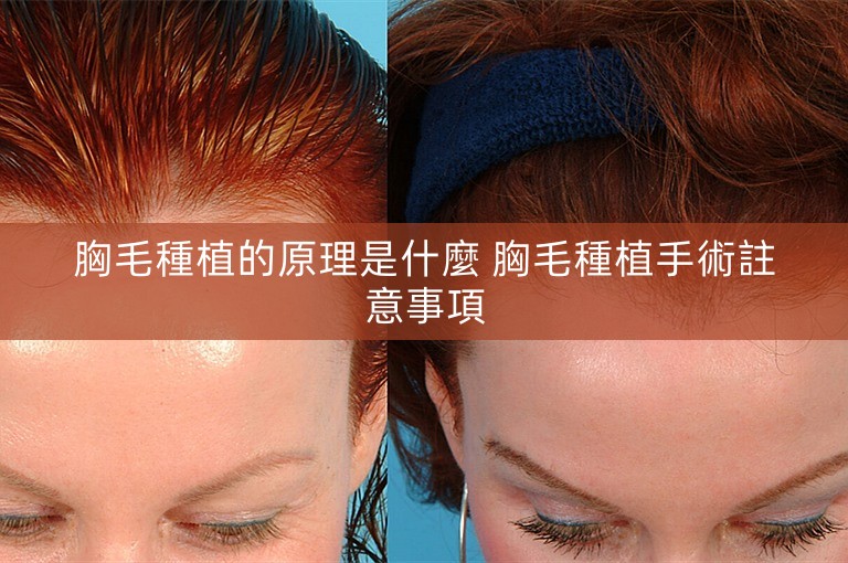 胸毛種植的原理是什麼 胸毛種植手術註意事項 胸毛種植的原理是什麼 胸毛種植手術註意事項