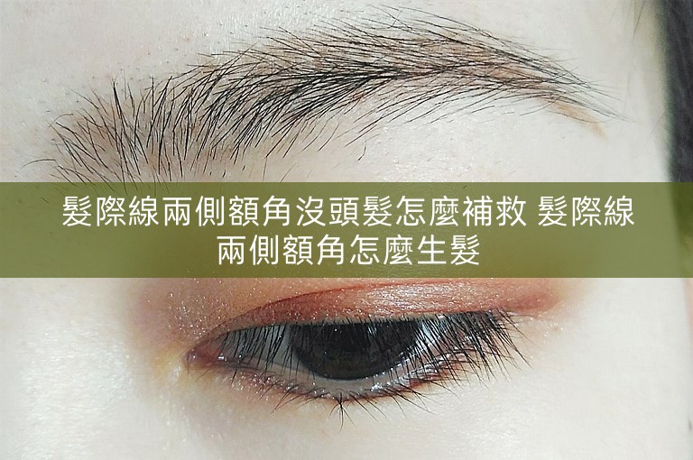 髮際線兩側額角沒頭髮怎麼補救 髮際線兩側額角怎麼生髮