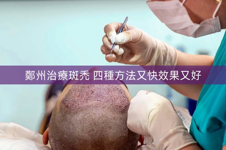 鄭州治療斑禿 四種方法又快效果又好