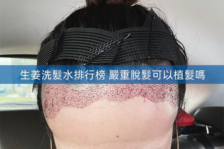 生姜洗髮水排行榜 嚴重脫髮可以植髮嗎
