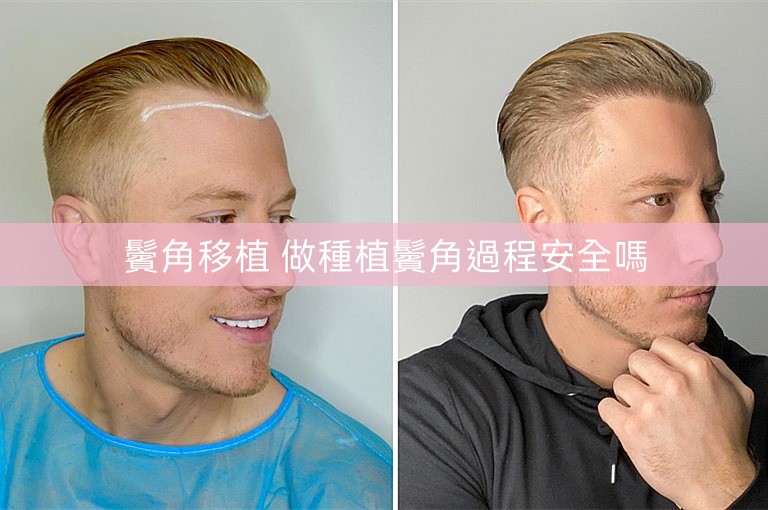 鬢角移植 做種植鬢角過程安全嗎
