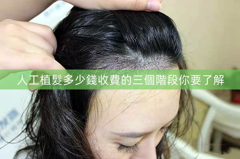 人工植髮多少錢收費的三個階段你要了解